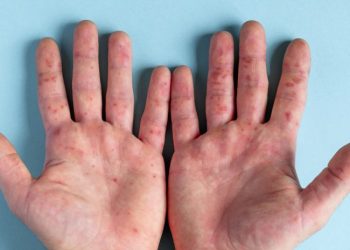 “პომიდვრის გრიპი” – ინდოეთში ახალი ვირუსული ინფექცია ვრცელდება