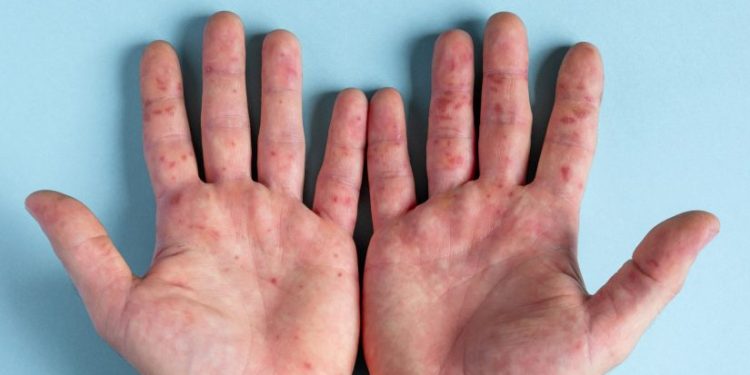 “პომიდვრის გრიპი” – ინდოეთში ახალი ვირუსული ინფექცია ვრცელდება