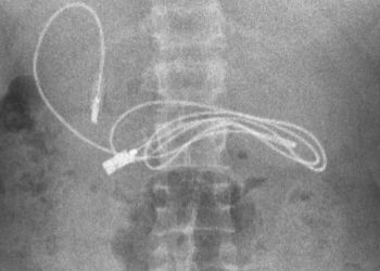 თურქეთში 15 წლის ბიჭს მუცლიდან USB კაბელი ამოუღეს