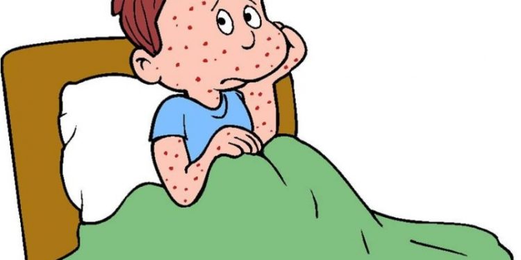 რიგ სამედიცინო დაწესებულებაში, ჩუტყვავილით ინფიცირებულთა მიმართვიანობამ მოიმატა