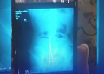 თბილისში ოპერაციისას ქალს მუცლის ღრუში მაკრატელი ჩაუტოვეს