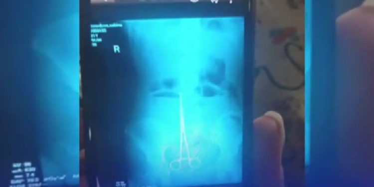 თბილისში ოპერაციისას ქალს მუცლის ღრუში მაკრატელი ჩაუტოვეს