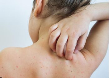 სამედიცინო დაწესებულებაში, ჩუტყვავილით და ქუნთრუშით ინფიცირებული ბავშვების მიმართვიანობა გაიზარდა