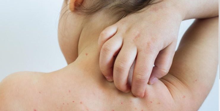 სამედიცინო დაწესებულებაში, ჩუტყვავილით და ქუნთრუშით ინფიცირებული ბავშვების მიმართვიანობა გაიზარდა