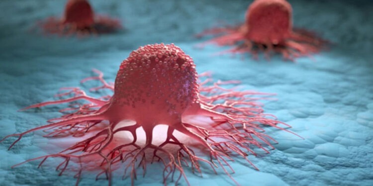 კიბოს დიაგნოზის მაჩვენებელი, 50 წელს ქვემოთ 80%-ით გაიზარდა – კვლევა