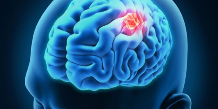 მსოფლიოში პირველი ბავშვი, რომელიც თავის ტვინის იშვიათი კიბოსგან სრულად განიკურნა –