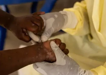 ევროპაში „მაიმუნის ყვავილის“ პირველი შემთხვევა დაფიქსირდა