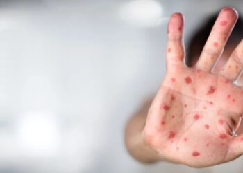 რომელი ვირუსების გააქტიურებაა მოსალოდნელი თებერვალში?