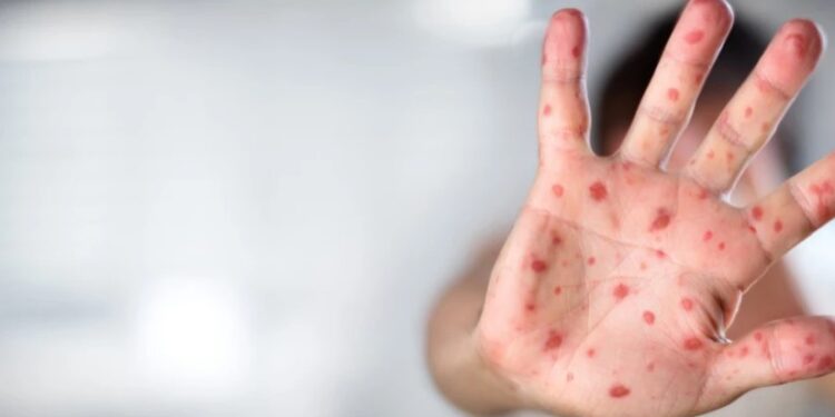 რომელი ვირუსების გააქტიურებაა მოსალოდნელი თებერვალში?