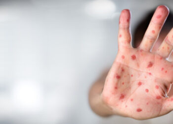 ბოლო 25 წლის მანძილზე ევროპაში წითელას ყველაზე მაღალი მაჩვენებელი დაფიქსირდა – UNICEF, WHO/EUROPE