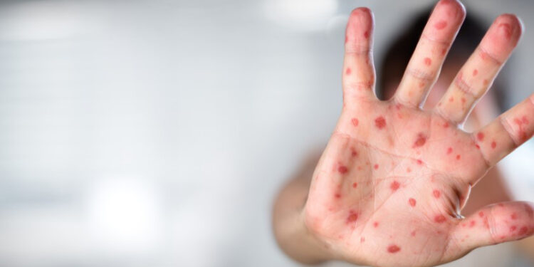 ბოლო 25 წლის მანძილზე ევროპაში წითელას ყველაზე მაღალი მაჩვენებელი დაფიქსირდა – UNICEF, WHO/EUROPE