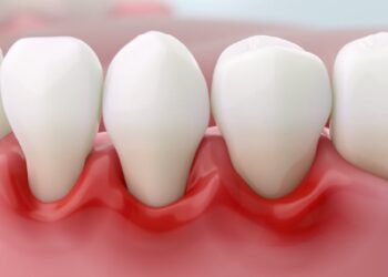 კარიესის მკურნალობა: ინოვაციური მიდგომები და უმტკივნეულო შედეგი