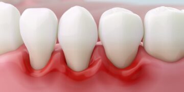 კარიესის მკურნალობა: ინოვაციური მიდგომები და უმტკივნეულო შედეგი