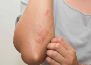 ოზურგეთის რამდენიმე საჯარო სკოლაში მუნის შემთხვევები დაფიქსირდა