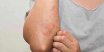 ოზურგეთის რამდენიმე საჯარო სკოლაში მუნის შემთხვევები დაფიქსირდა